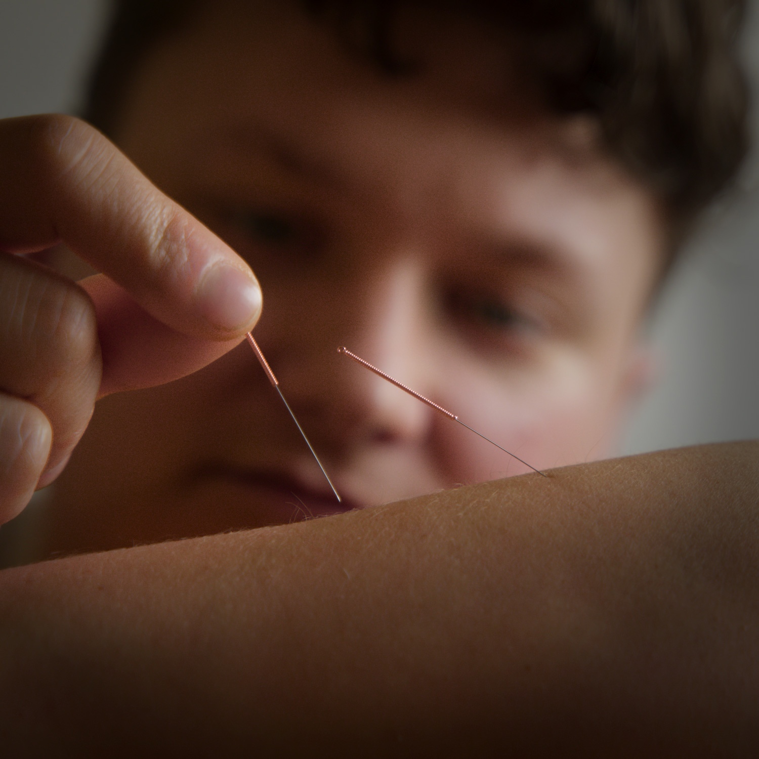 Séance d'acupuncture avec aiguilles